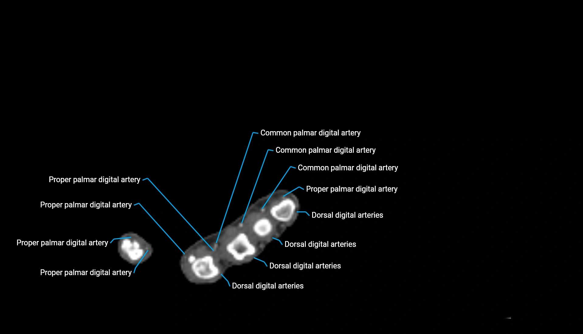 CTA upper limb axial cross sectional anatomy labelled image 46 (2).webp
